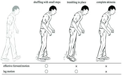 Intelligent diagnosis system based on artificial intelligence models for predicting freezing of gait in Parkinson’s disease